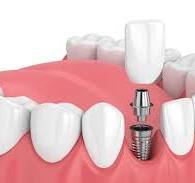 Implants