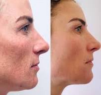 Pigmentation Treatment